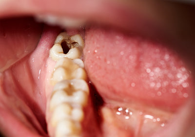 What Causes Cavities?
